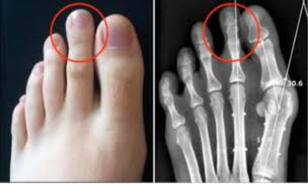 【驚愕】足の人差し指が親指より長い人は要注意！！生涯影響するデメリットが…