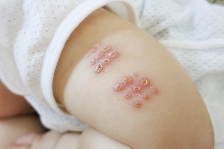 朗報　日本型BCG予防接種が新型コロナウイルスに効果ありかも！